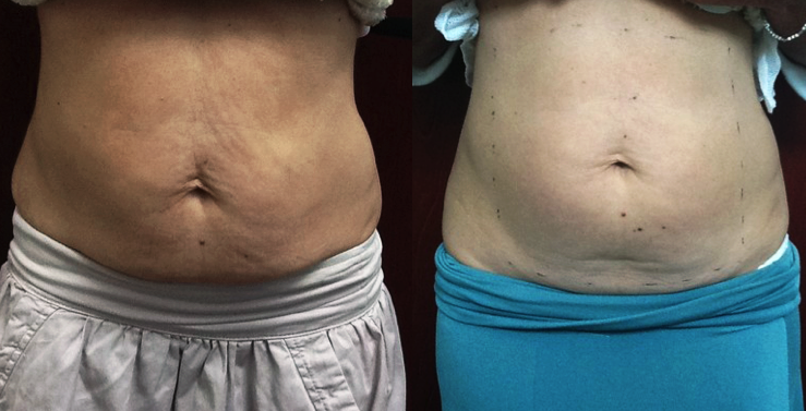 RF Skin Tightening