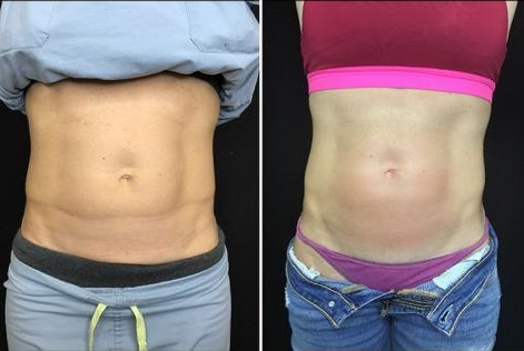 Exilis-Abdomen-before-and-after-abs-are-firmer-and-tighter