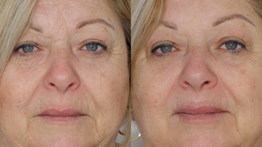 before-after-2